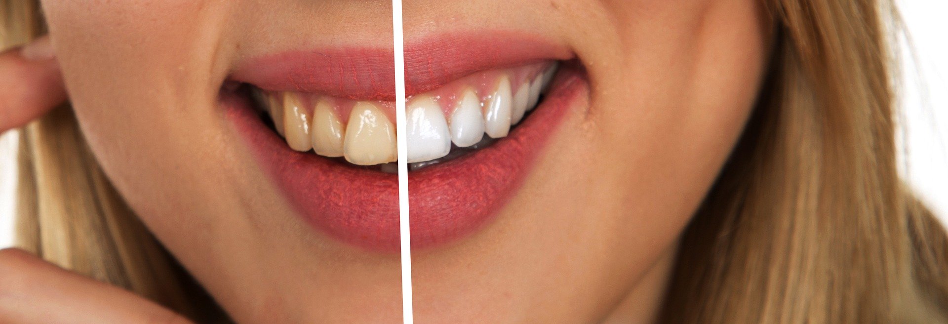 Simple Ways to Naturally Whiten Your Teeth - The Blessed Seed